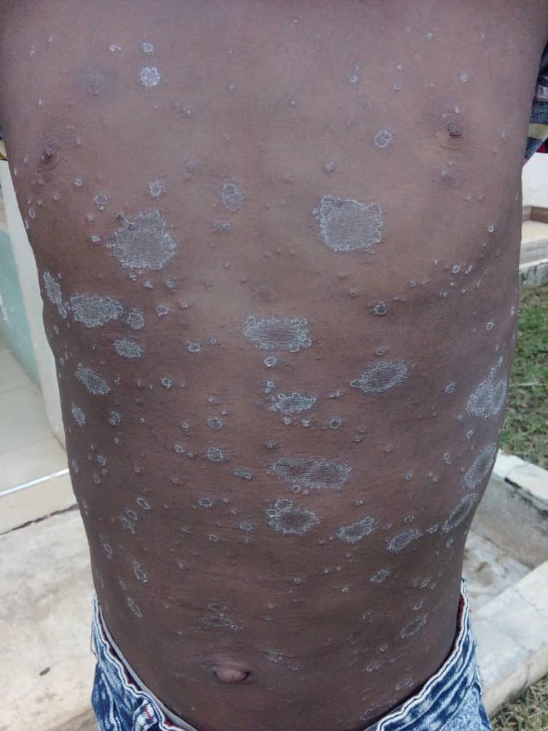 Sekyere East District Health Directorate appeals for public support in battle against NTDs 3 WhatsApp Image 2023 12 26 at 10.29.53