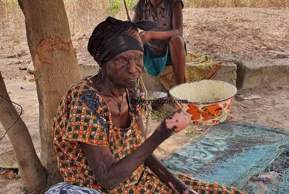 Story of the 80-year-old leper abandoned by her children