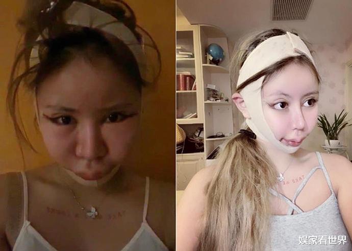 16-year-old girl allegedly undergoes 100 cosmetic procedures in 3 years