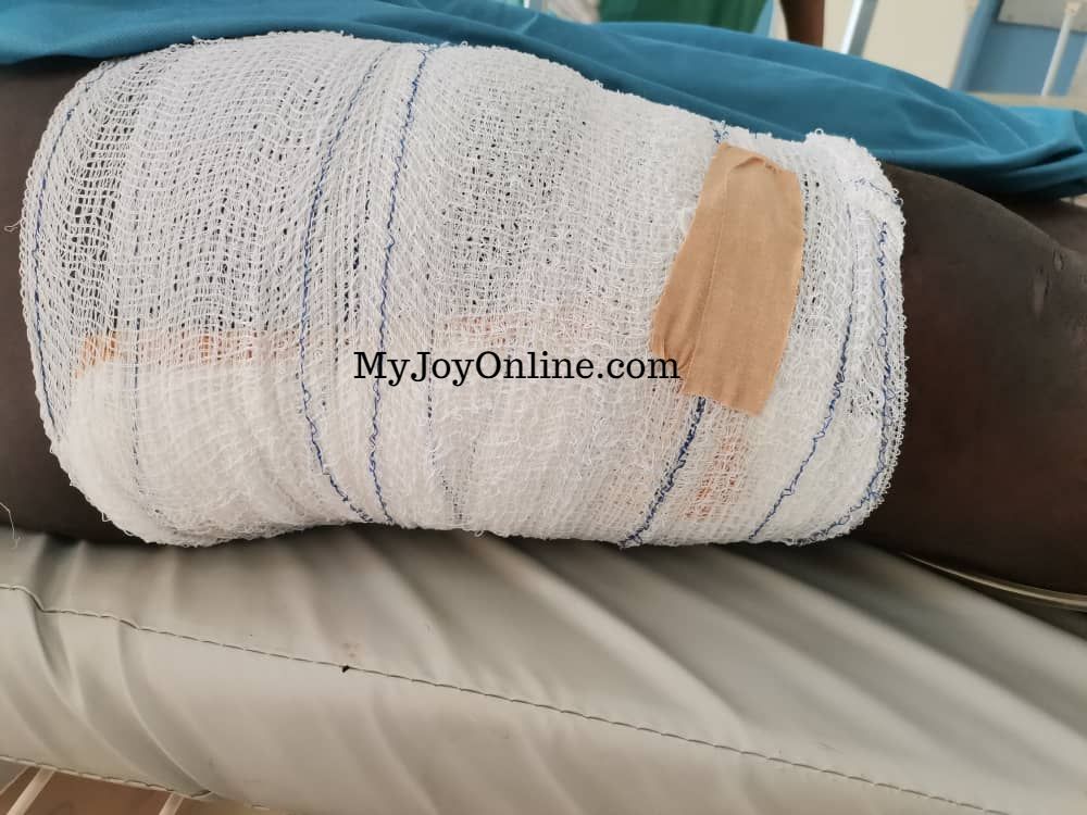 Wa attack: Man assaulted by soldiers undergoes surgery after fracturing thigh bone Wa attack: Man assaulted by soldiers undergoes surgery after fracturing thigh bone