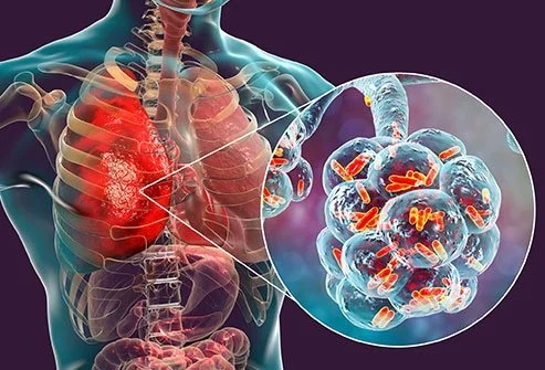 legionellosis travel associated outbreak