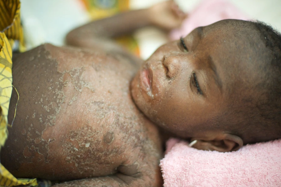 10 cases of measles recorded in Ketu South