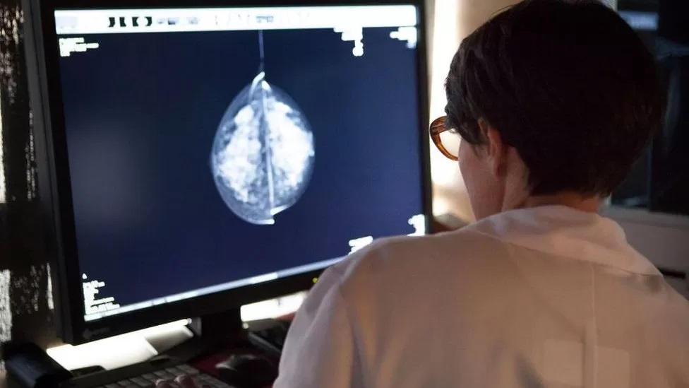 How AI is helping doctors spot breast cancers - Vimarsana News