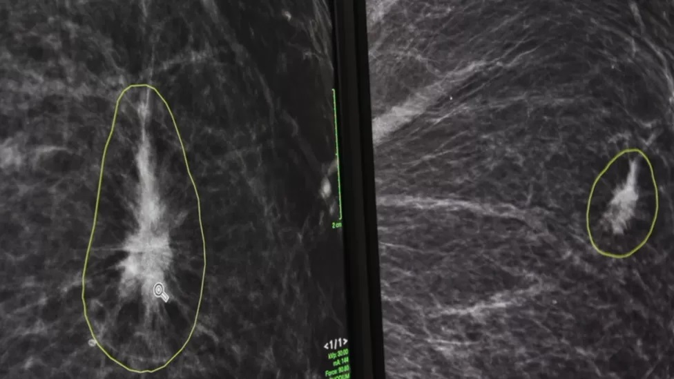 How AI is helping doctors spot breast cancers