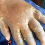 Skin disease outbreak leaves Mepe-Avetakpo residents in agony Skin disease outbreak leaves Mepe-Avetakpo residents in agony