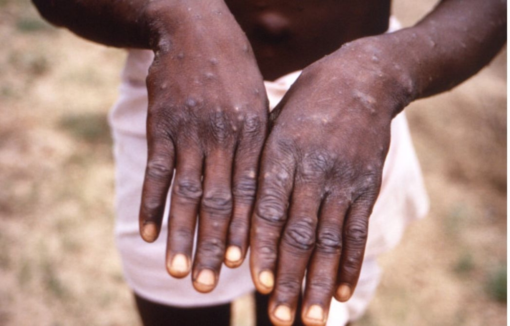 Mpox concerns heighten as Ashanti Region tests 10 suspected cases – MyJoyOnline