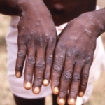 Mpox concerns heighten as Ashanti Region tests 10 suspected cases
