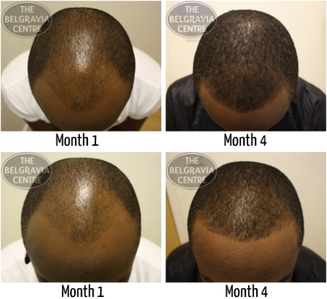 UGMC announces rollout of hair transplant in Ghana this year – MyJoyOnline