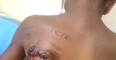 Mother faces Ho court for allegedly burning son over lost pen – MyJoyOnline