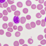 Joy Cancer Awareness Month: Expert warns parents on early signs and treatment of childhood leukaemia Joy Cancer Awareness Month: Expert warns parents on early signs and treatment of childhood leukaemia