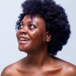 Burned at age 10, stigmatised but unafraid of never getting a husband - A burn survivor’s story