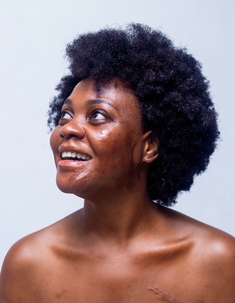 Burned at age 10, stigmatised but unafraid of never getting a husband – A burn survivor’s story – MyJoyOnline