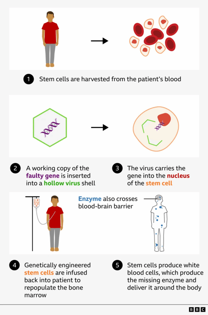 Boy with rare condition amazes doctors after world-first gene therapy