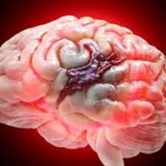 Urgent Appeal: Family seeks GH¢210,840 to save young woman battling life-threatening brain haemorrhage