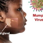 Mumps outbreak hits Keta Township, 50 affected