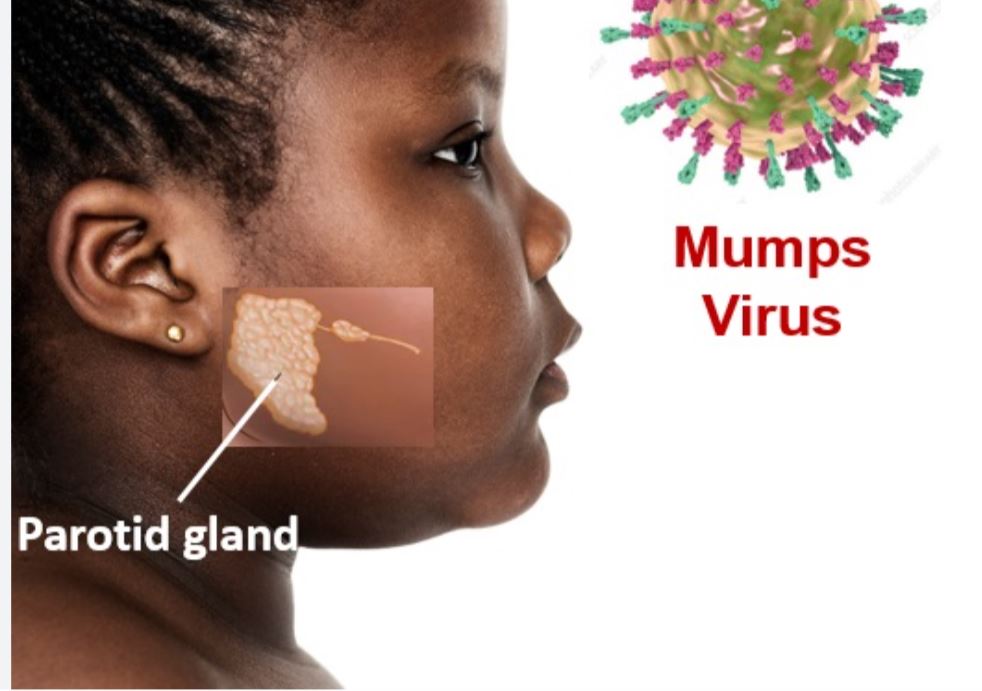 Mumps outbreak hits Keta Township, 50...