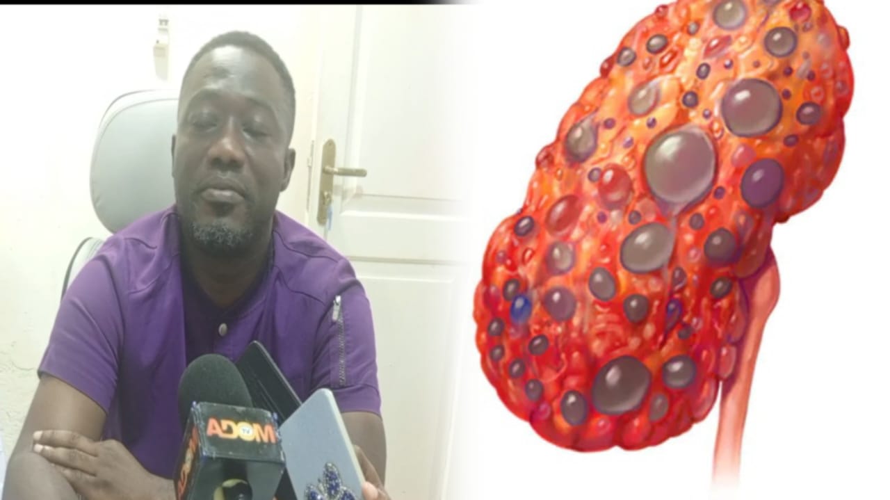 Ghana sees alarming increase in Kidney disease among children and adults