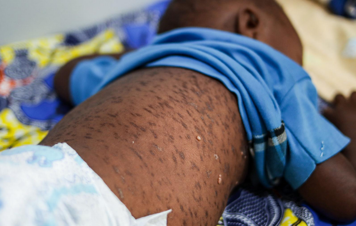 Measles and rubella cases rise across Africa as children bear the heaviest burden