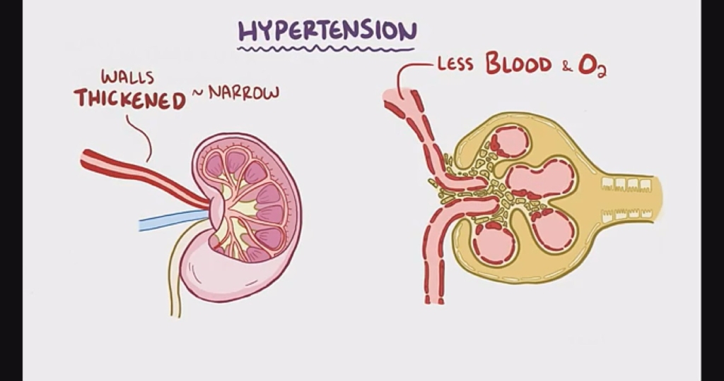 Hypertension rates rising in Ghana as many remain unaware of the condition – MyJoyOnline