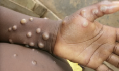 GHS confirms over 1000 cases of Mpox