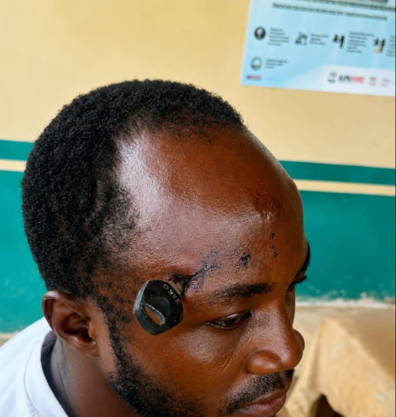 Doctors successfully remove motorbike key...