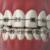 Braces beyond treatment: Gen Z’s fashion craze and the hidden dental risks