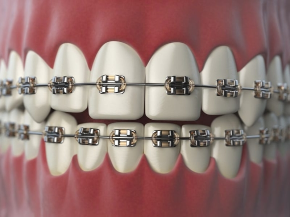 Braces beyond treatment: Gen Z's fashion craze and the hidden dental risks